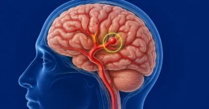 Brain Aneurysm