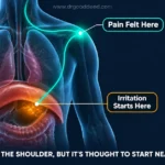 Why Does Gas Pain Go to My Shoulder?