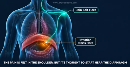Why Does Gas Pain Go to My Shoulder?
